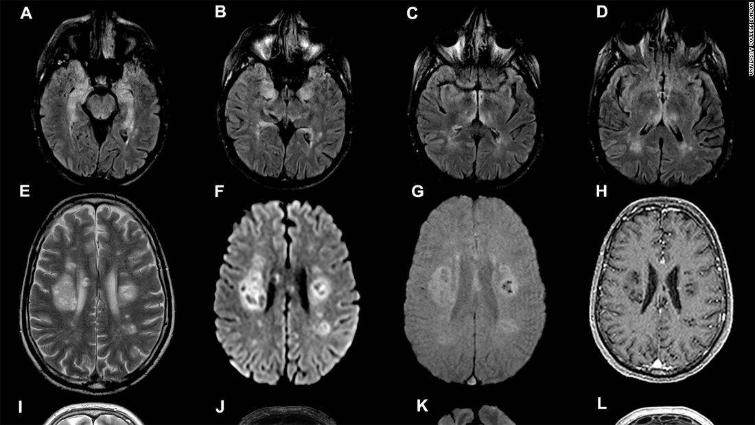Kerusakan otak dapat dikaitkan dengan Covid-19, para ilmuwan memperingatkan